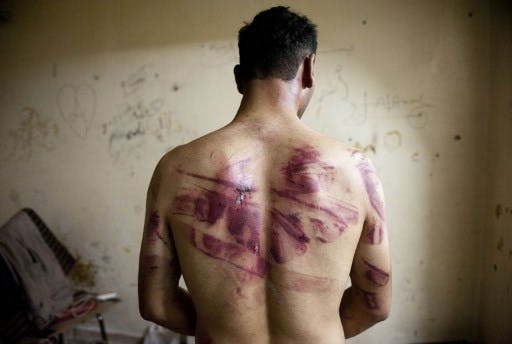 آثار شکنجه بر پشت مردی از اهالی حلب. هر کس در زندان‌های اسد بوده، چنین یادگارهایی بر تن دارد. (عکس از خبرگزاری فرانسه)
