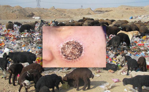 زخم بیماری پوستی لیشمانیازیس بر صورت – متن تصویر: دامداری در حاشیه شهر پیشوا؛ چرا در زباله‌دانی