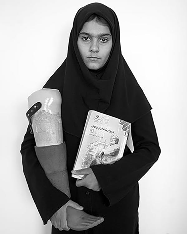 زنی معلول.از قربانیان جنگ ایران و عراق. پای مصنوعی در دست − عکس از مهدی منعم