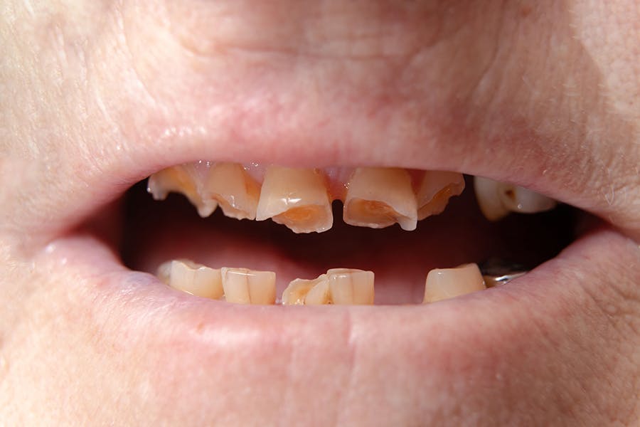 وضعیت دندان، از نشانه‌های کیفیت بهداشت و درمان و شکاف طبقاتی در هر کشوری است. عکس از Shutterstock